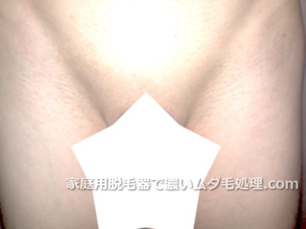 Vライン1回目剃った後sumb