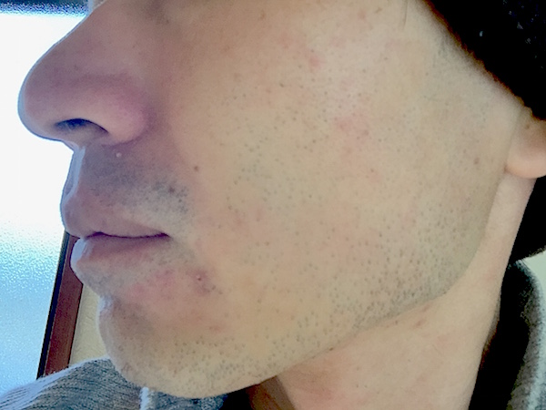 頬毛1回目剃った後sumb.jpeg 頬毛1回目剃った後sumb